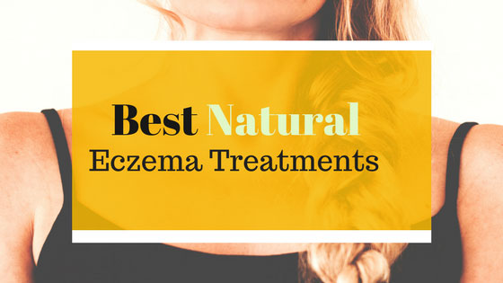 Best Natural Eczema Treatments
